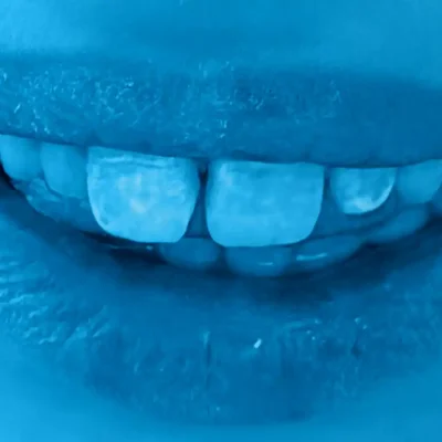 young-child-restores-confidence-filling-chipped-teeth-dental-procedure